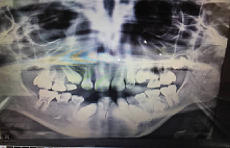 Figura. 2: Radiografía panorámica (tomada a los 11 años, en su primera visita a consulta) donde se observa la ausencia de 12 folículos permanentes, característico de una oligodoncia.