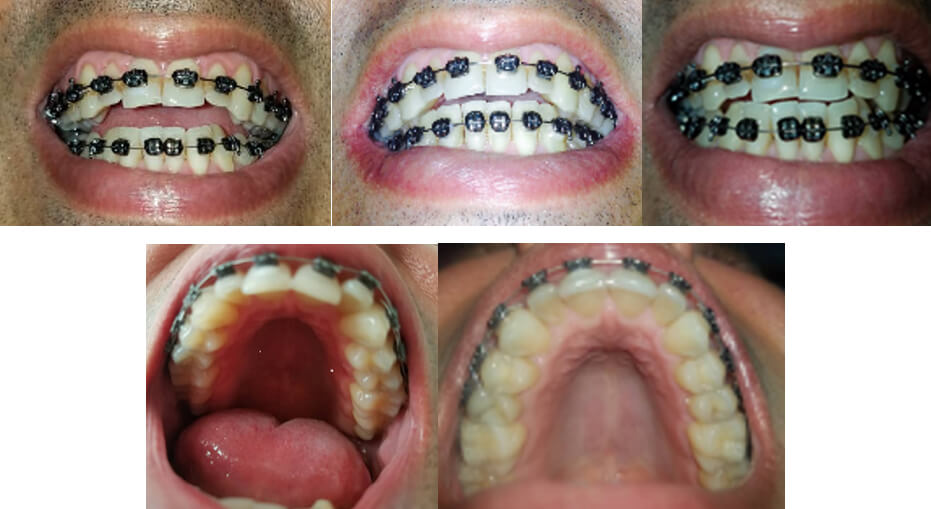 Figura #1. Inicio y transcurso del tratamiento de ortodoncia. Obsérvese presencia de apiñamiento y adaquia.