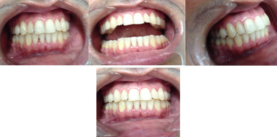 Figura #2. Después de concluido el tratamiento. Se aprecian arcadas alineadas y cierre de la mordida. Además de la mejora en la salud periodontal.