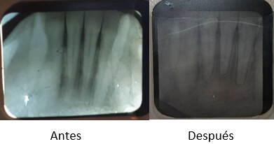 Figura #3.  Zona de incisivos antes y después del tratamiento. Se observa formación ósea que incrementó su altura entre las raíces de incisivos inferiores, después de eliminar el apiñamiento y aumentar el espacio interradicular.