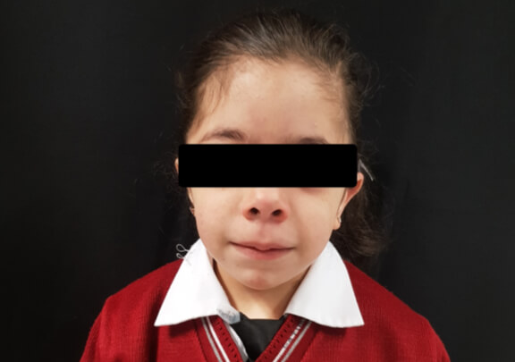 Figura 2. Fotografía extraoral de frente de la paciente, donde se observa el dismorfismo facial.