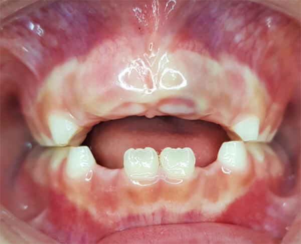 Figura 4. Fotografía intraoral de Quiste Bilateral en órganos dentarios #21 y #11.