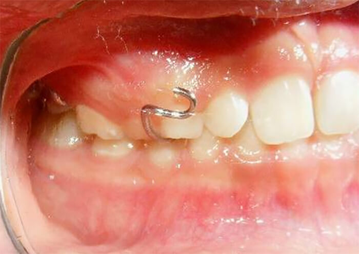 Fig. 15 Lateral derecha