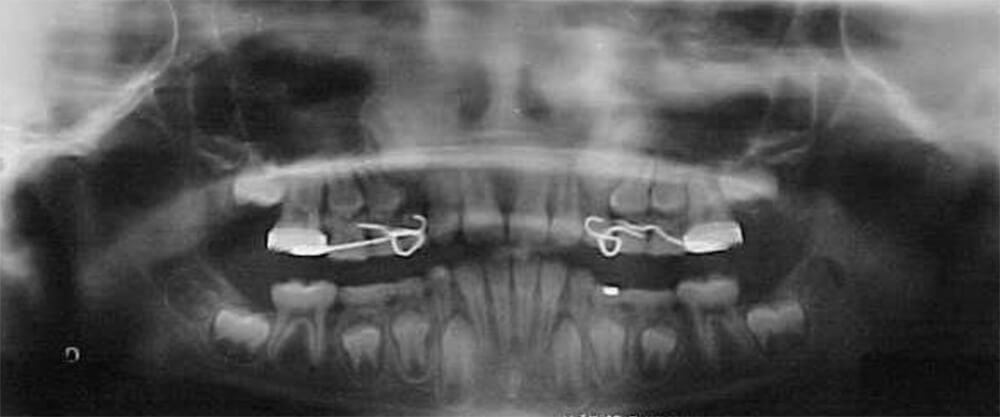 Fig. 19 Ortopantomografía final