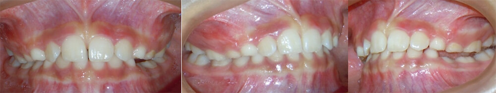 Fig. 20 Intrabucal de frente lateral derecha e izquierda