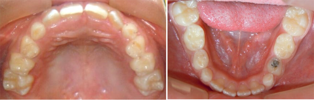 Fig. 21 vista oclusal superior e inferior