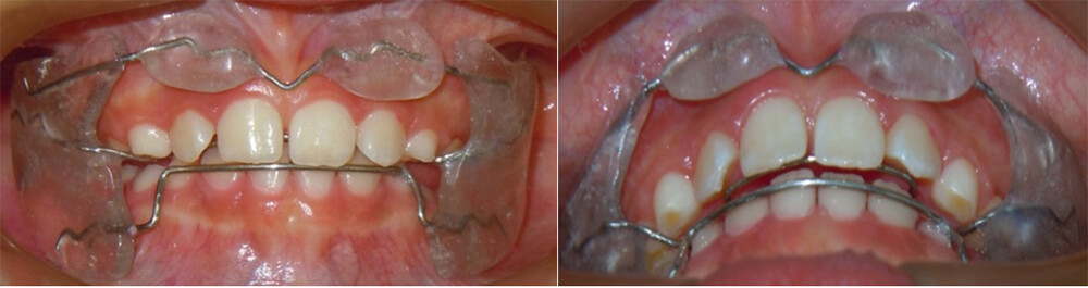 Fig. 22 Intrabucal de frente