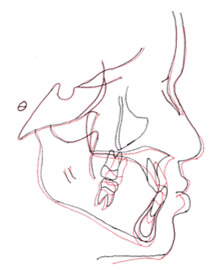 Fig. 23 Sobreimposición sobre base craneal