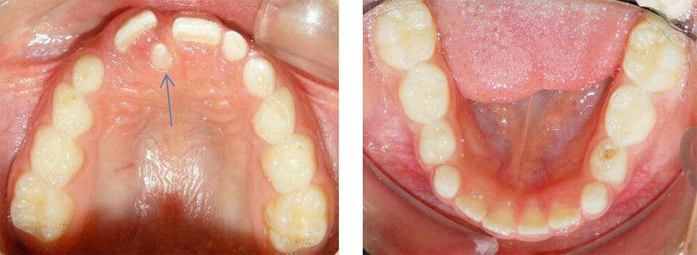 Fig.5  Oclusal superior