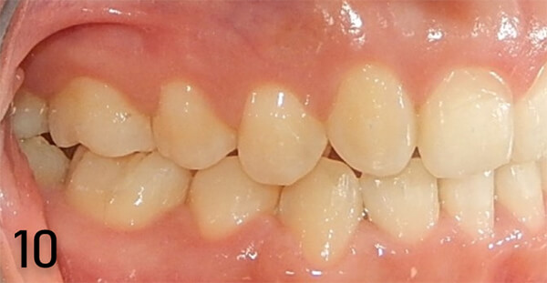 Fig. 13 derecha final