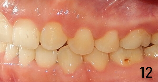 Fig. 15 izquierda final