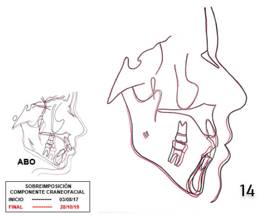 Fig. 14 Sobreimposición inicio final.