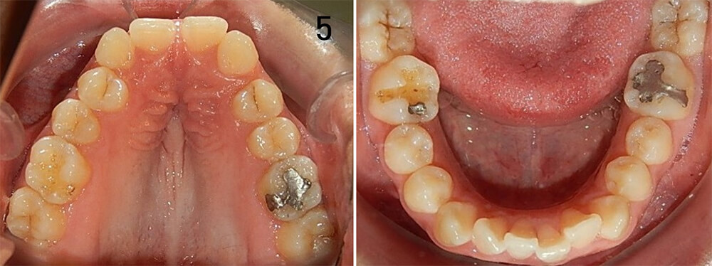 Fig. 5 vista oclusal superior e inferior