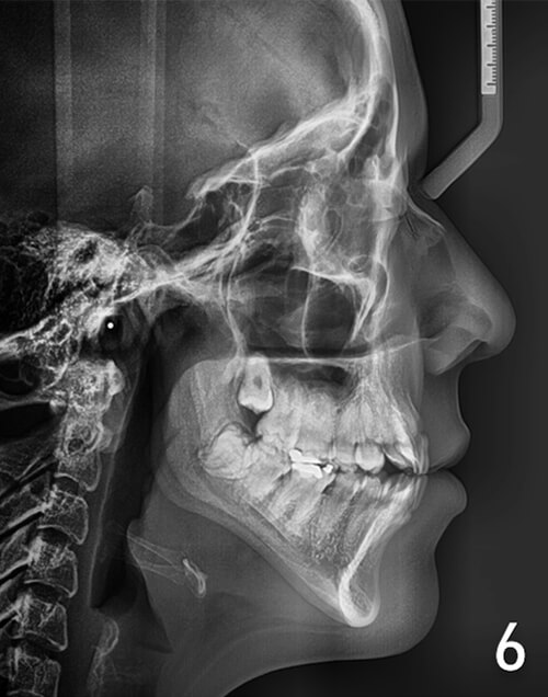 Fig. 6 Radiografía lateral de cráneo inicial