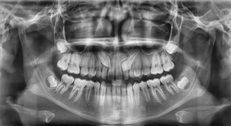 Fig. 1 Radiografía panorámica de una inclusión dentaria, su relación con las estructuras adyacentes, y dirección de caninos superiores.