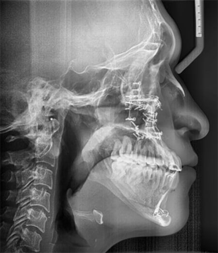 Fig 10. Correción maxilomandibular