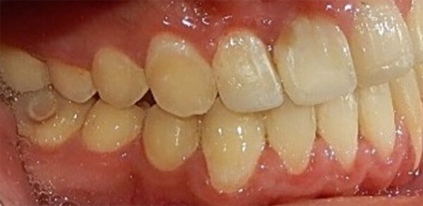 Fig 12. Lateral derecha, frente, izquierda final.