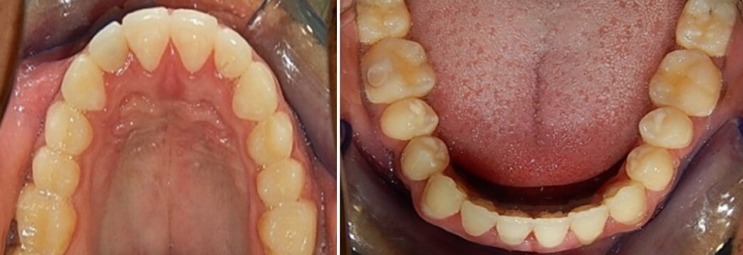 Fig. 13. Oclusal superior e inferior final