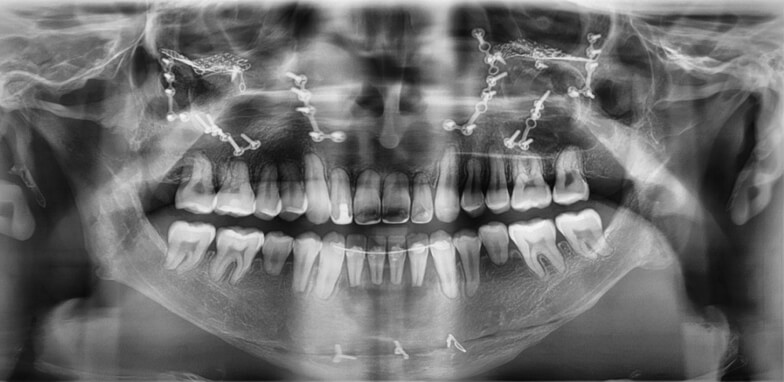 Fig 14. Radiografia panoramica final, ausencia terceros molares.