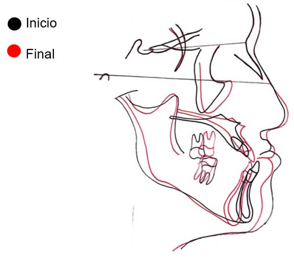 Fig 15. Sobreimposición inicio/final.