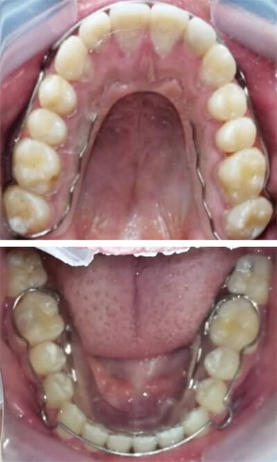 Fig. 18 Vista Oclusal retenedores circunferenciales superior e inferior.