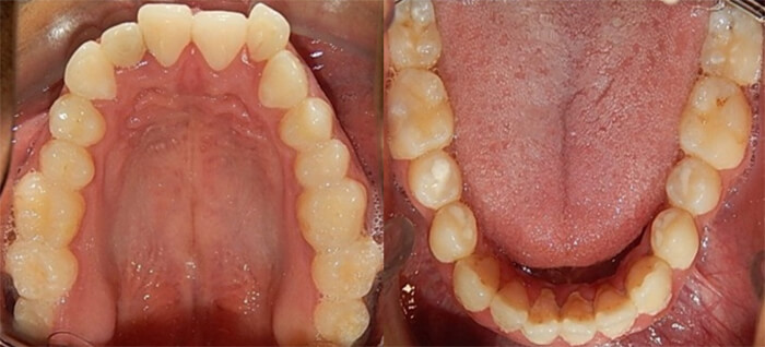 Fig. 3 Vista oclusal forma cuadrada apiñamiento leve