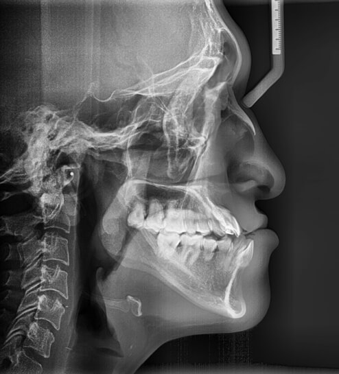 Fig. 4 Radiografía lateral, crecimiento hipodivergente, proclinación de incisivos.