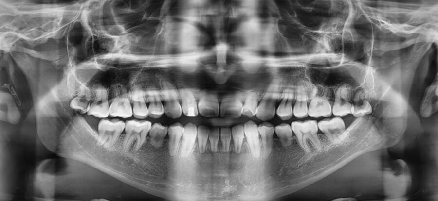 Fig. 5 Ausencia de terceros molares inferiores