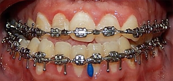 Fig.7 Brackets de forma pasiva