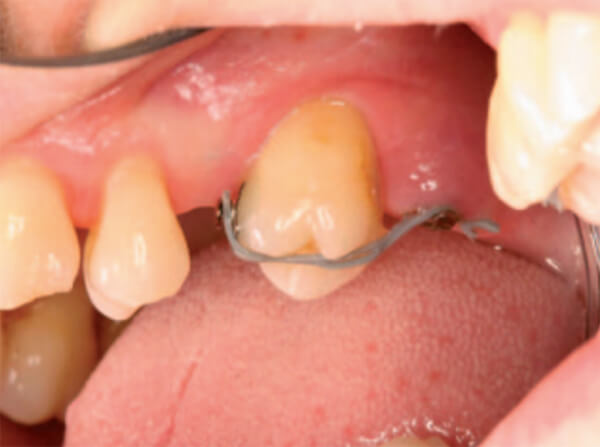 Figura. 2 Intrusión Molar (cadena elastomérica sujeta a mini-implantes)