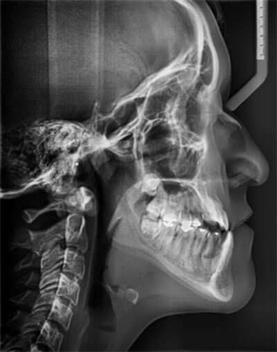 Fig. 1 radiografía lateral de cráneo