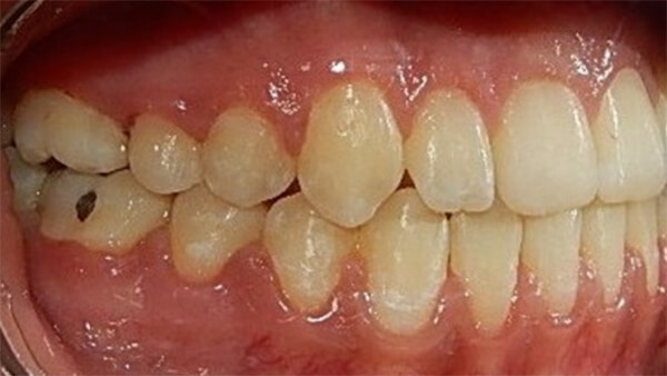 Fig. 17 lateral derecha