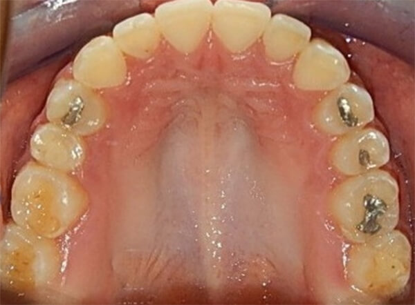 Fig. 19 oclusal superior final inferior