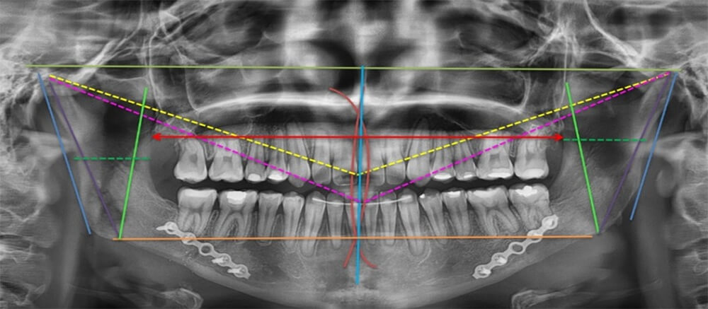 Fig. 20 Rx panorámica final