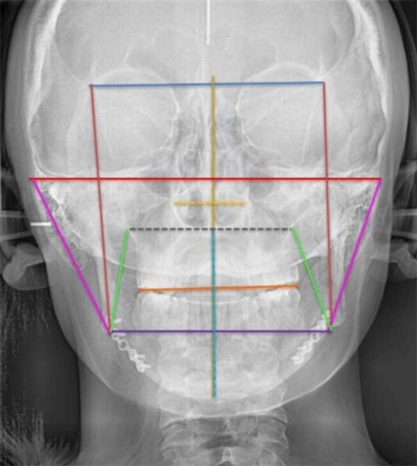 Fig. 21 Rx postero anterior final