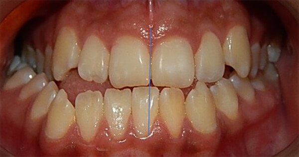 Fig. 24 intraorales de frente comparativas inicio – final