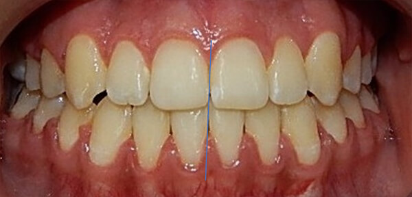 Fig. 24 intraorales de frente comparativas inicio – final