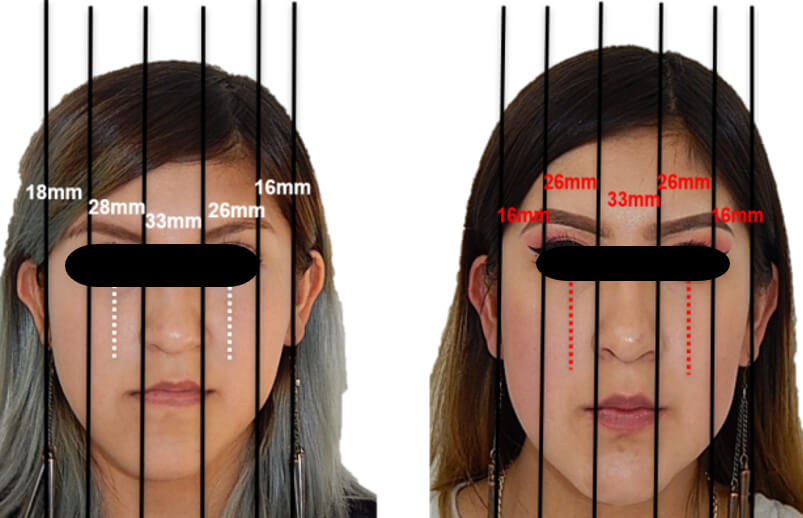 Fig. 25 frente extraoral comparativas inicio, final