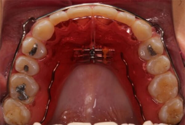 Fig. 26 intraorales con circunferenciales, expansor superior y en oclusión