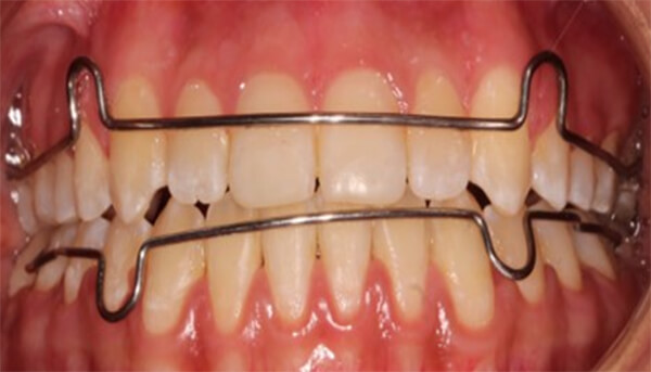 Fig. 26 intraorales con circunferenciales, expansor superior y en oclusión