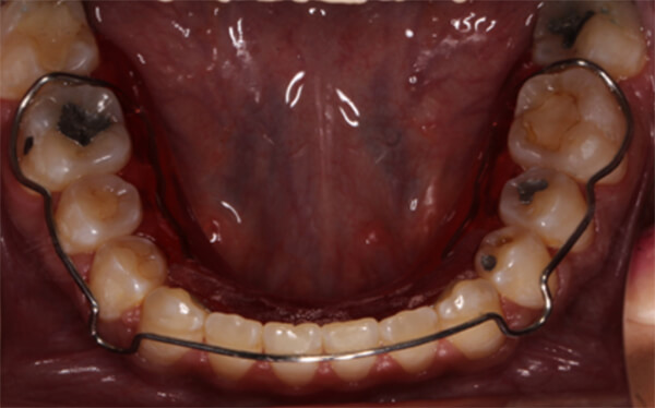 Fig. 26 intraorales con circunferenciales, expansor superior y en oclusión