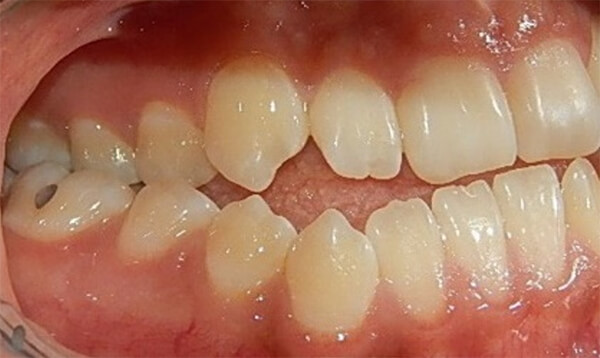 Fig. 3 intraoral derecha