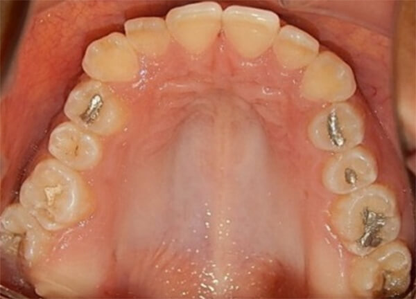 Fig. 6 oclusal superior e inferior