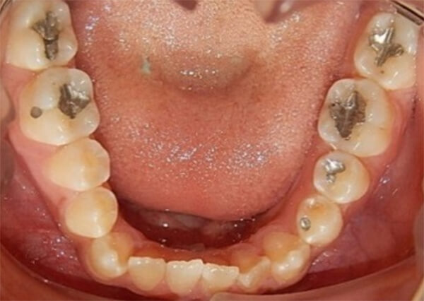 Fig. 6 oclusal superior e inferior