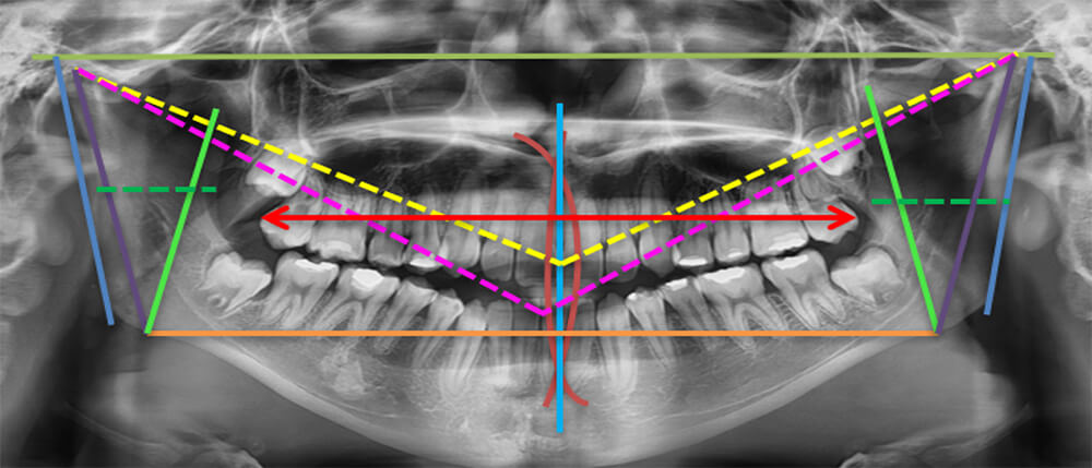 Fig. 7 Rx panorámica