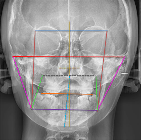 Fig. 8 Rx postero anterior