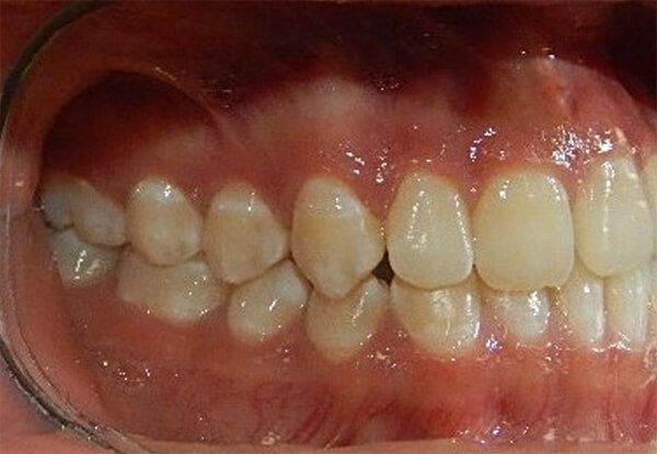 Fig. 1 Intraoral derecha