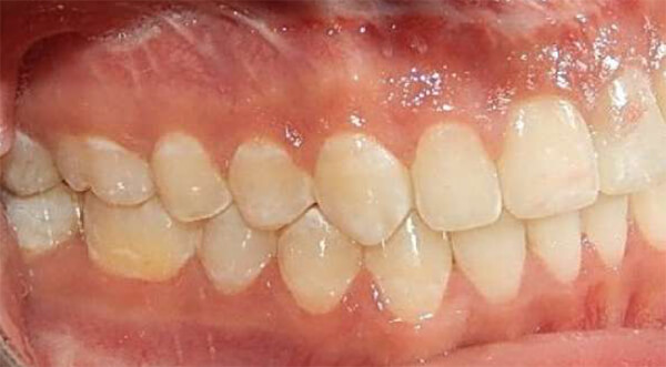 Fig. 10 Intraoral derecha - final