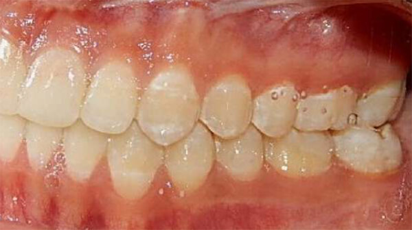 Fig. 11 Intraoral izquierda - final