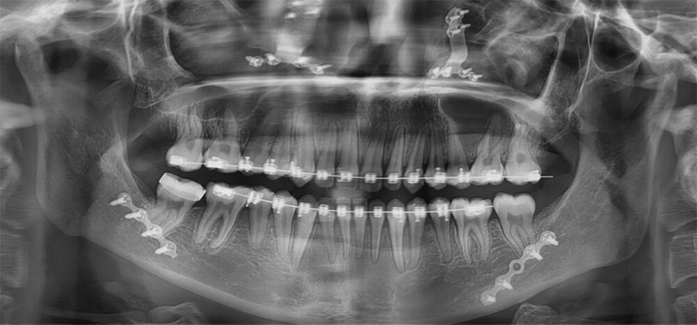 Fig. 12 Radiografía panorámica final